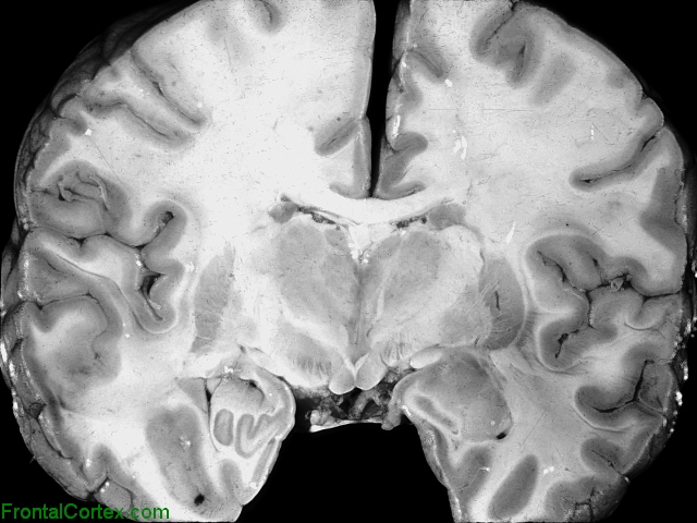 Diffuse cerebral edema, coronal section at the level of the thalamus